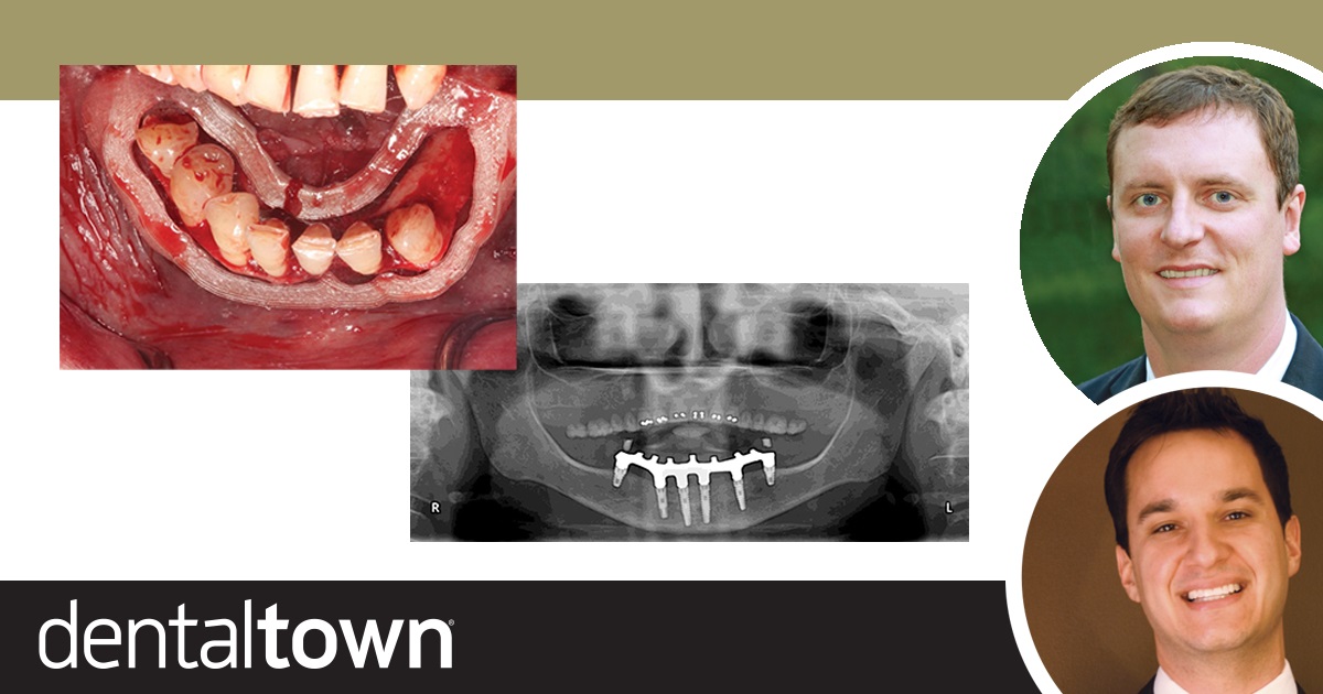 Advanced Full-Arch  Implant Surgery Drs. Cory Glenn and Danny Domingue discuss a full-arch implant case that used a surgical guide 3D printed in the dental practice, and compare the case’s accuracy to a similar one performed without such a guide.