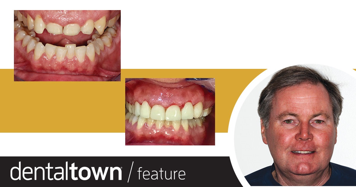 Show Your Work (Worn) Down But Not Out Dr. Terry Shaw, a Townie with hundreds of followers on the Dentaltown message boards, shares a case in which he rebuilt a patient’s dentition using composite material.