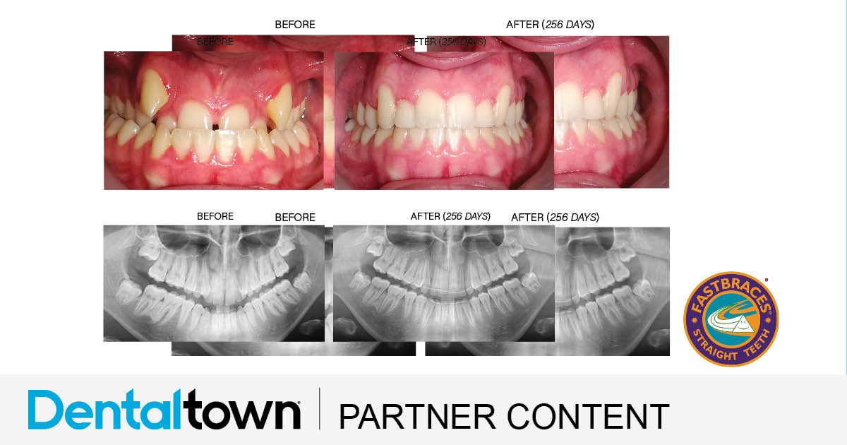 Product Profile: Fastbraces The cupping depth of the alveolar bone