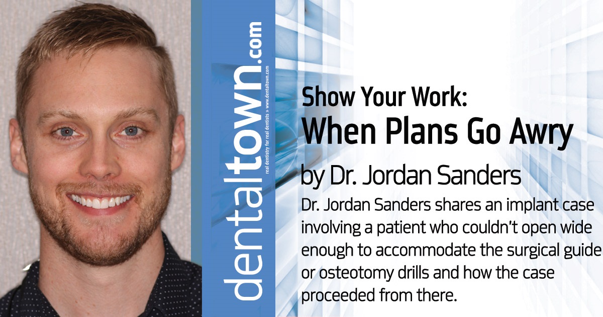 Show Your Work: When Plans Go Awry Dr. Jordan Sanders shares an implant case involving a patient who couldn’t open wide enough to accommodate the surgical guide or osteotomy drills and how the case proceeded from there.