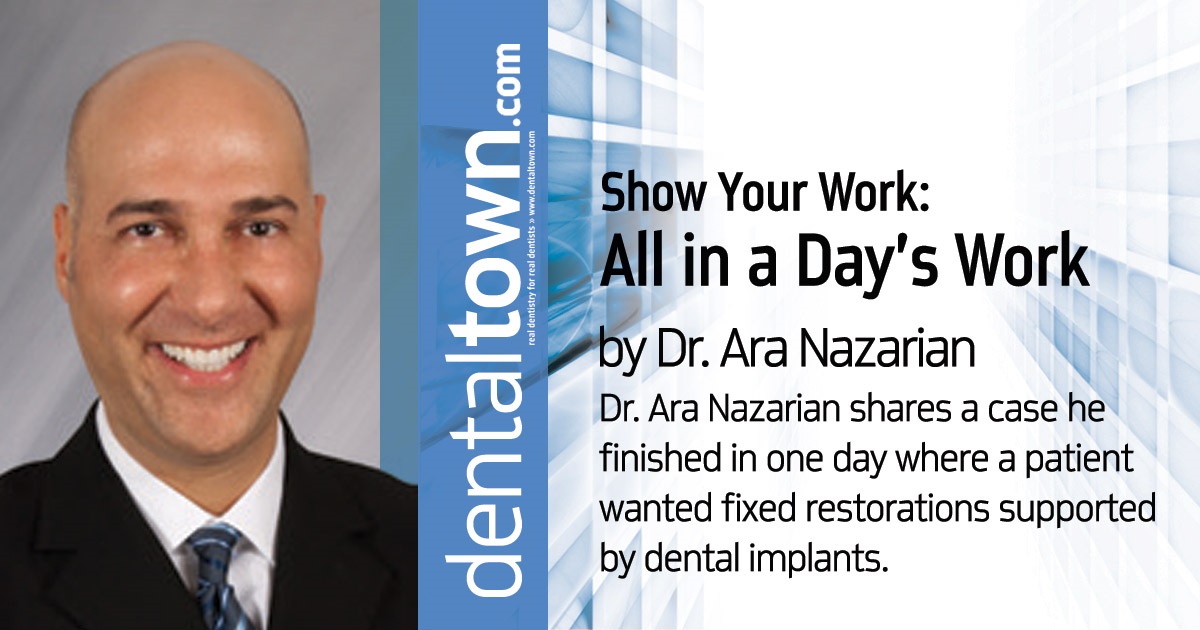 Show Your Work: All in a Day’s Work Dr. Ara Nazarian shares a case he finished in one day where a patient wanted fixed restorations supported by dental implants. 