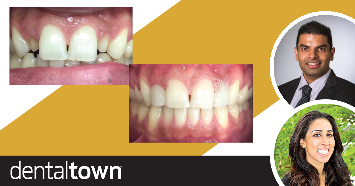 Show Your Work: 3-Visit Smile Reconstruction Drs. Sanna Charlie and Ram Vaderhobli share an elective minimally invasive approach to restore a patient’s maxillary peg laterals.