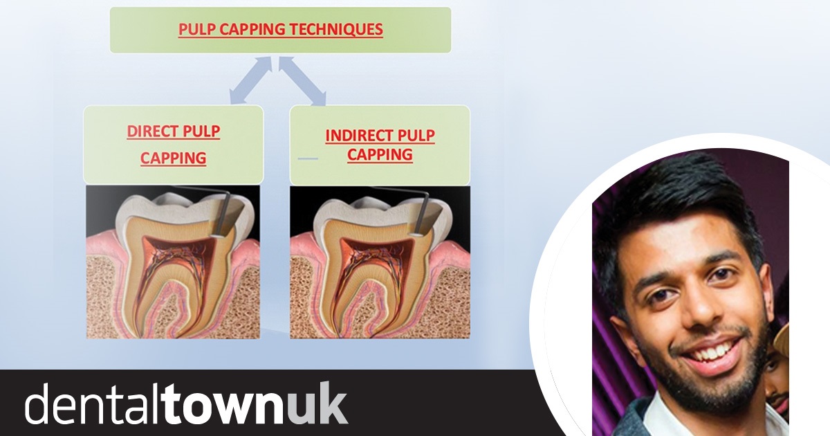 The Power of the  Pulp (Part 1) In this two-part article, Dr Kishan Sheth discusses the importance of the pulpal tissues in regeneration and function of the living tooth (part 1), and presents a balanced view of the different materials on the market which clinicians are using or have used as pulp capping materials (part 2).