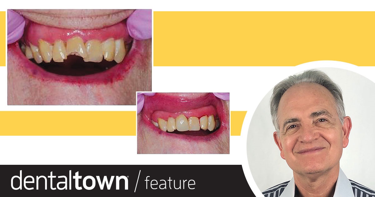 Show Your Work: Treating an Aging Population Dr. Raymond Kimsey shares a geriatric dentistry case in which he placed a direct restoration for a 94-year-old patient with Alzheimer’s disease, utilizing a crown form and composite.