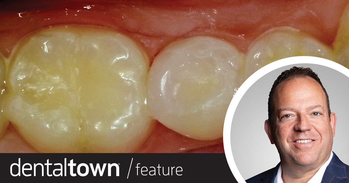 Show Your Work: Warm Up to Something New Dr. Ron Kaminer illustrates the use of a thermoviscous nanohybrid composite that was developed specifically to be heated for ease of placement in a bulk fashion.