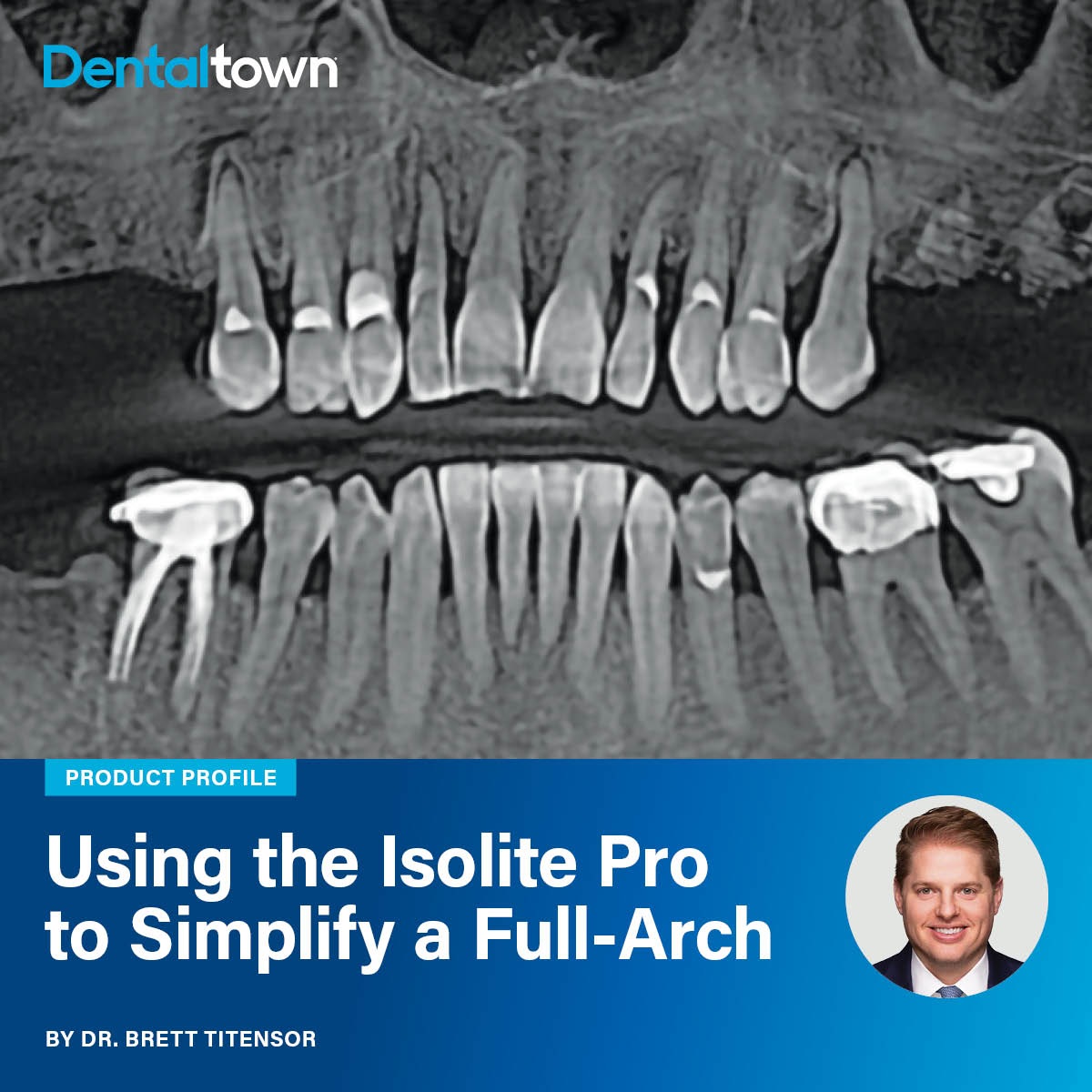 Clinical Case Spotlight: Using the Isolite Pro to Simplify a Full-Arch Implant Case Dr. Brett Titensor uses the Isolite Pro to streamline, protect and expedite full-arch implant surgery.