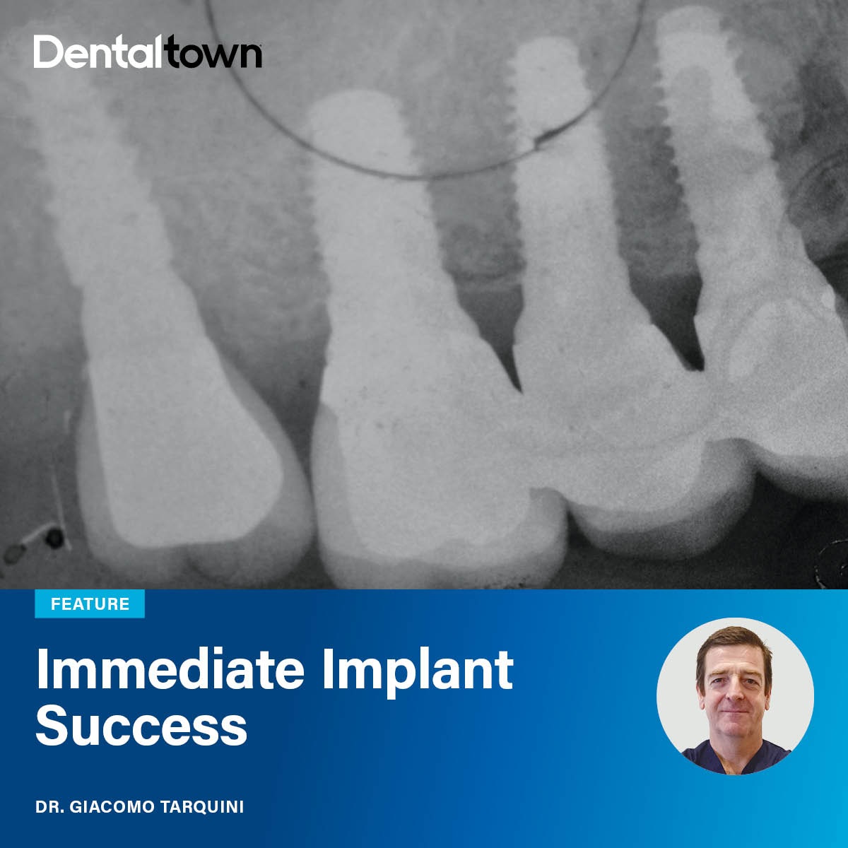 Immediate Implant Success Dr. Giacomo Tarquini details ultrasonic cavitation techniques for successful immediate implants in infected sockets.
