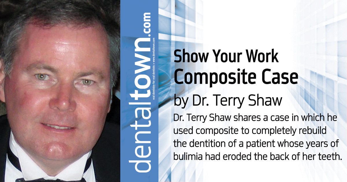 Show Your Work: Composite Case Dr. Terry Shaw shares a case in which he used composite to completely rebuild the dentition of a patient whose years of bulemia had eroded the back of her teeth. 