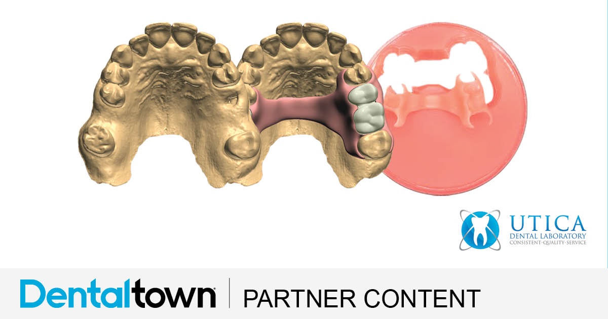 Product Profile: TCS 3D Flexible Partials A complete digital solution for partial dentures