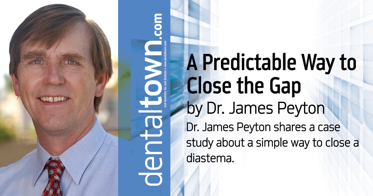 A Predictable Way to Close the Gap Dr. James Peyton shares a case study about a simple way to close a diastema. 