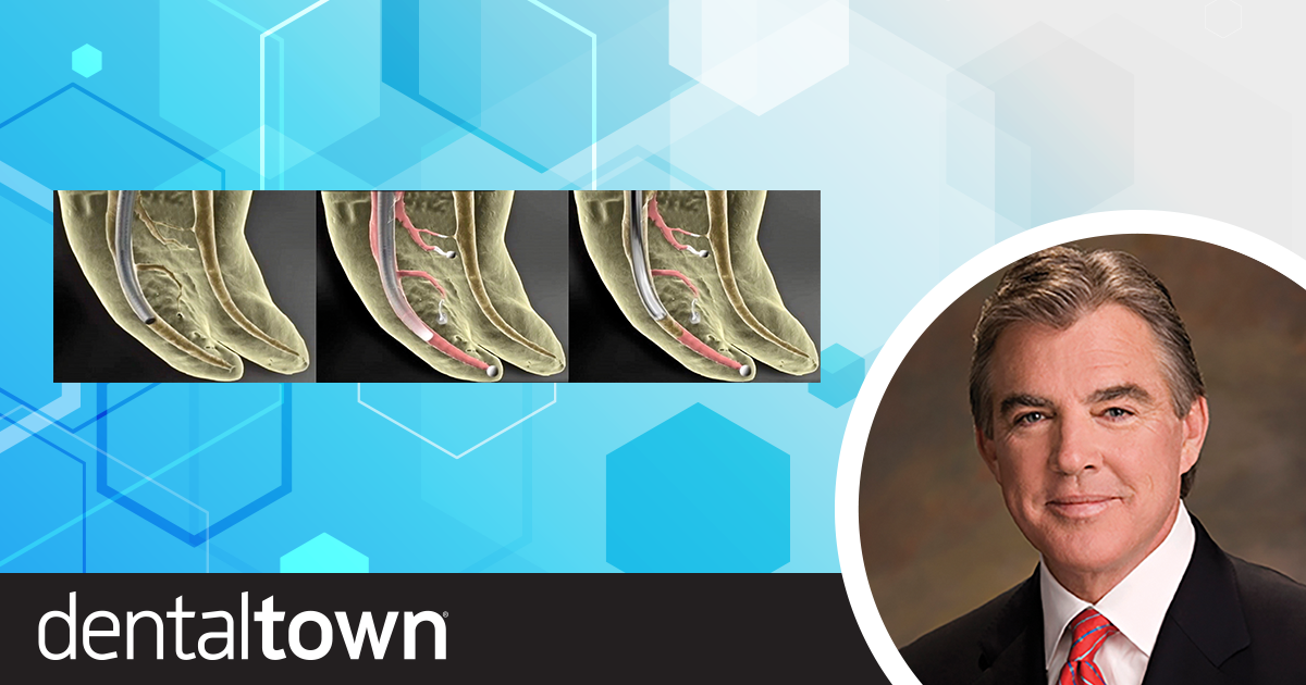 Endodontic Treatment in the Age of Bioceramics  Endodontist Dr. L. Stephen Buchanan recently changed sealer brands after 40 years and shares why this was beneficial in his practice.