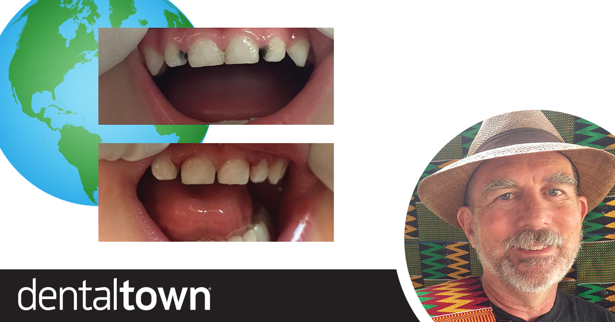 Following the Smart Silver Trail Dr. Steve Duffin discusses the use of silver diamine fluoride to treat patients in the U.S. and abroad.