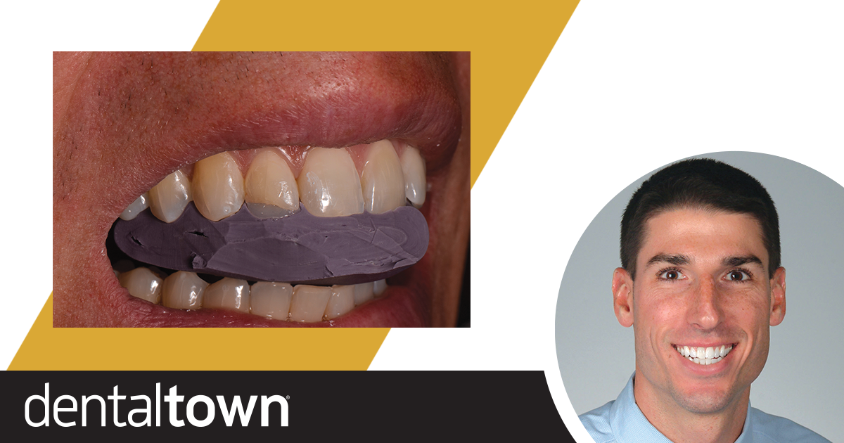 Show Your Work: In-Office Restorations Dr. Anthony Mennito discusses a recent direct Class IV restoration of an anterior tooth on a patient with high standards—a prosthodontist and fellow colleague.