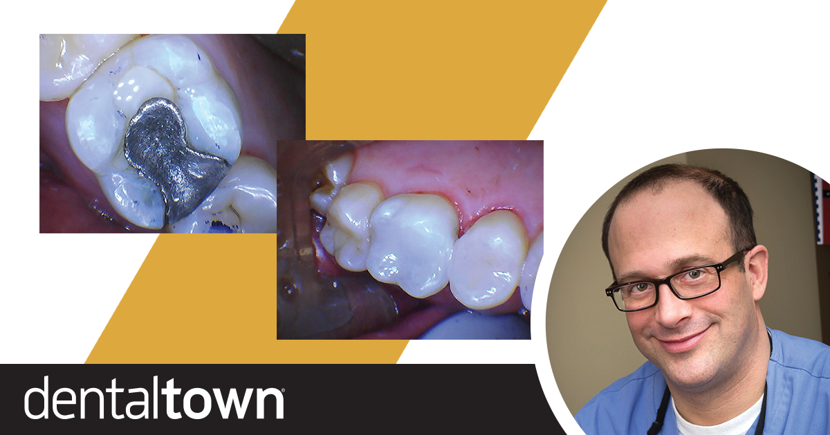 Show Your Work: Working at Light Speed Dr. Joshua Weintraub shares a case in which he used a laser to remove old amalgam and prepare teeth for restoration. The ability to forgo anesthetic and traditional instruments helped him shave a half-hour off the time required to perform the procedure.
