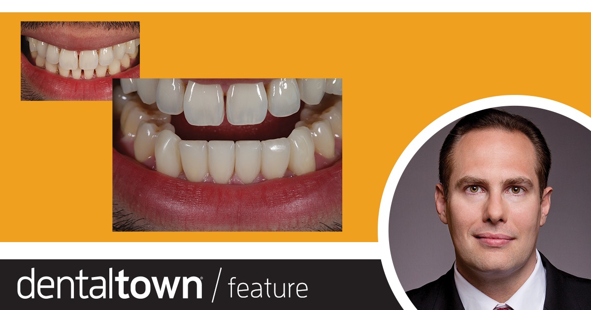 Show Your Work: A New Technique for New Patients Dr. Arthur Volker shares a direct composite case study in which he treated a patient’s lower anterior black triangles—a challenge because of the small area dentists need to get into.
