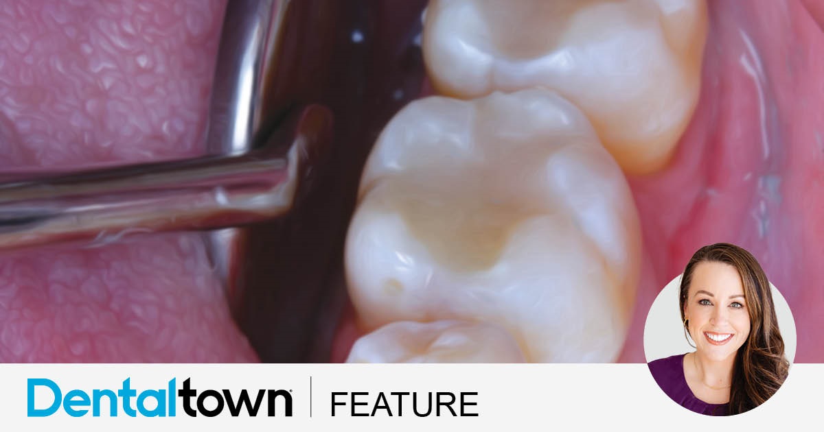 Posterior Protocol When Dr. Christina Pruitt’s patient complained of cold sensitivity, she discovered his old amalgam restorations were failing. To save existing tooth structure as well as money, he opted for direct composite restorations instead of an indirect crown—and he was so pleased with the result, he scheduled an appointment so Pruitt could replace two other, nonfailing amalgam fillings on the opposite side of his lower arch as well.