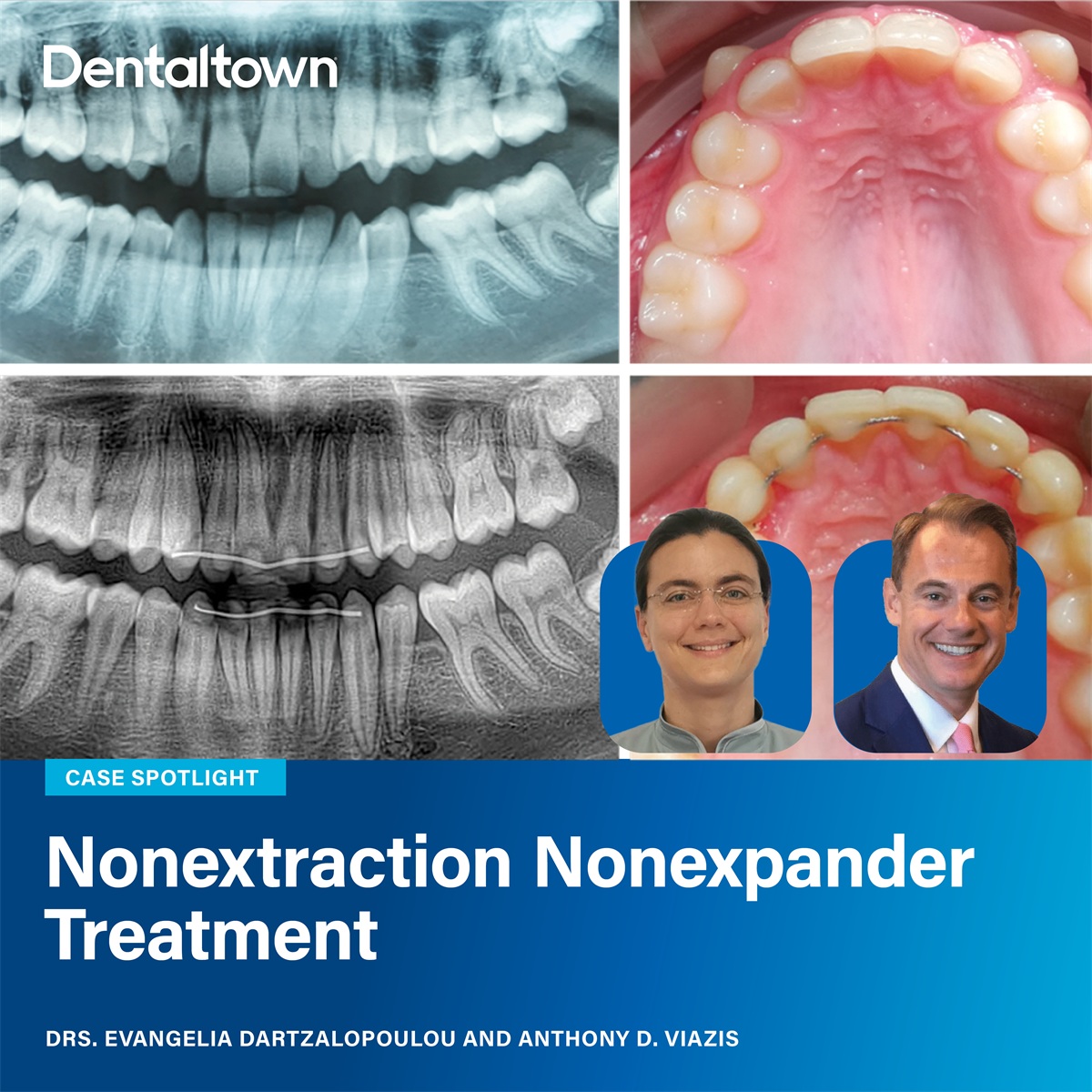 Clinical Case Spotlight: Nonextraction Nonexpander Treatment Drs. Evangelia Dartzalopoulou and Anthony Viazis detail a 123-day nonextraction, nonexpansion orthodontic case using only Fastbraces brackets and one archwire to achieve full alignment.