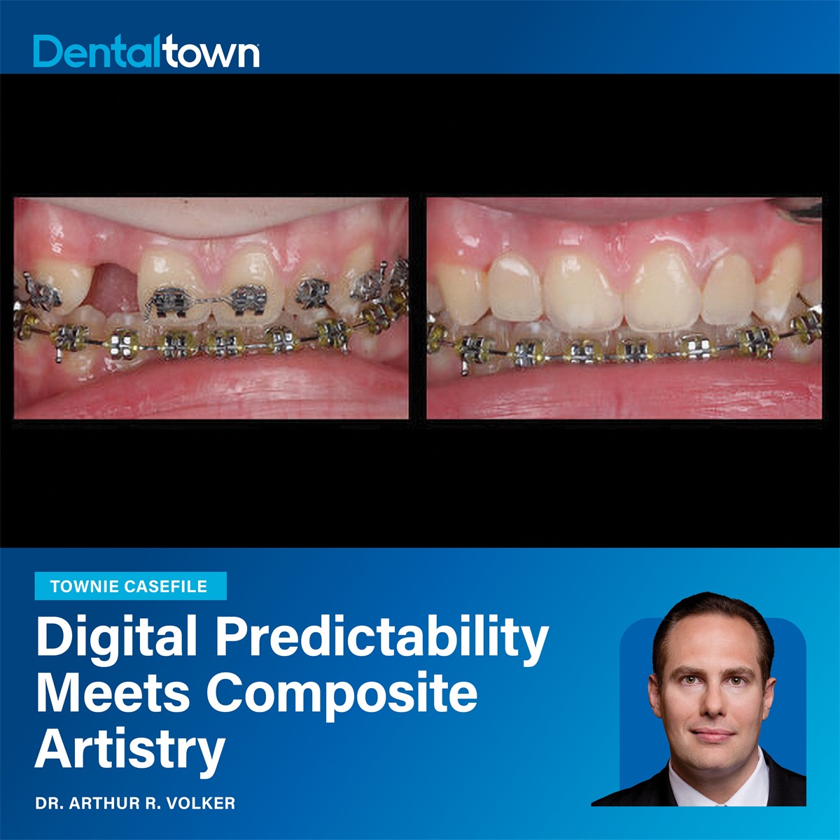 Townie Casefile: Digital Predictability Meets Composite Artistry Dr. Arthur Volker restores a missing lateral incisor using a 3D-printed Maryland bridge and composite artistry, showcasing digital precision and lifelike aesthetics.