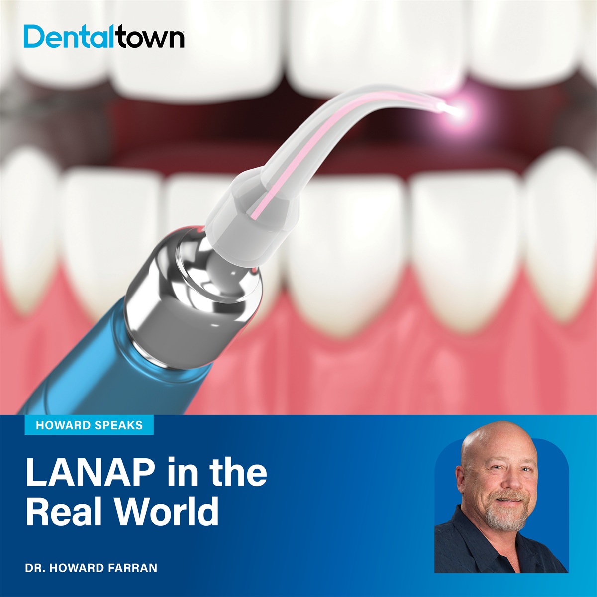 LANAP in the Real World Dr. Howard Farran examines the debate surrounding LANAP, its clinical success stories, economic realities, scientific scrutiny, and the balance between innovation, evidence and patient trust.