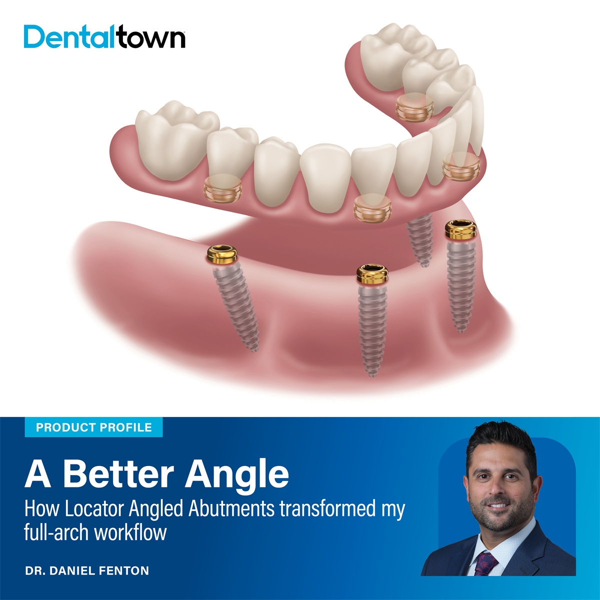 Why I Made the Switch: A Better Angle How Locator Angled Abutments transformed Dr. Daniel Fenton's full-arch workflow