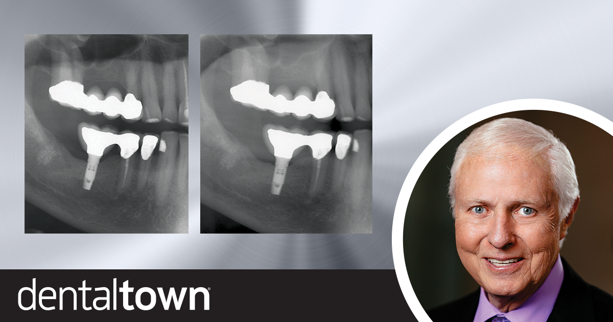 Should Implants Be Connected to Natural Teeth?   Dr. Gordon Christensen shares how, and when, to connect implants to natural teeth.
