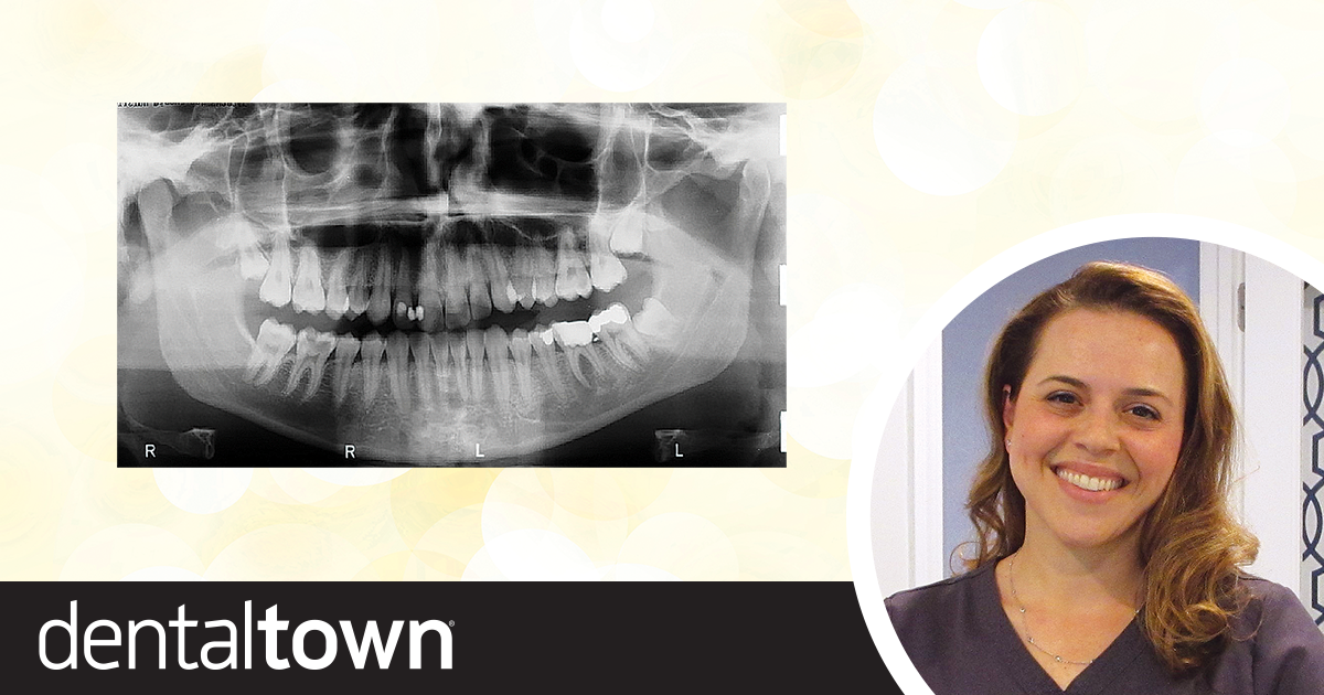 Continuing Education: Transplanting Molars Dr. Judy McIntyre discusses endodontic autotransplantation techniques—moving one tooth to another location in the mouth—and shares a case in which she moved two third molars to first-molar position?… and includes a 13-year follow-up report.