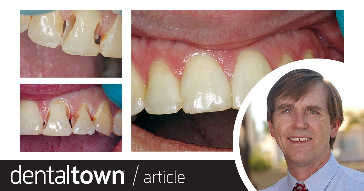 Show Your Work: Restoring Large Class III Cavities with a One-Shade Composite Dr. Jim Peyton shares a case involving a patient whose blood pressure medication led to dry mouth and significant tooth decay, which he restored with a one-shade universal composite.