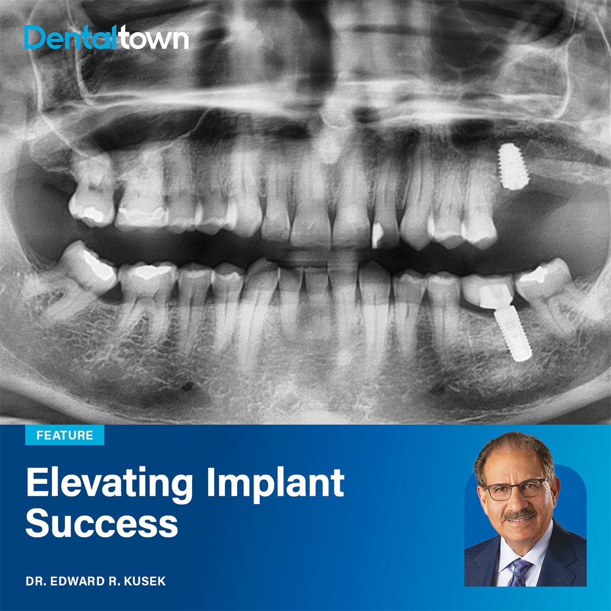 Elevating Implant Success Dr. Ed Kusek details a laser-assisted lateral sinus lift case that restores bone height and supports predictable implant placement.
