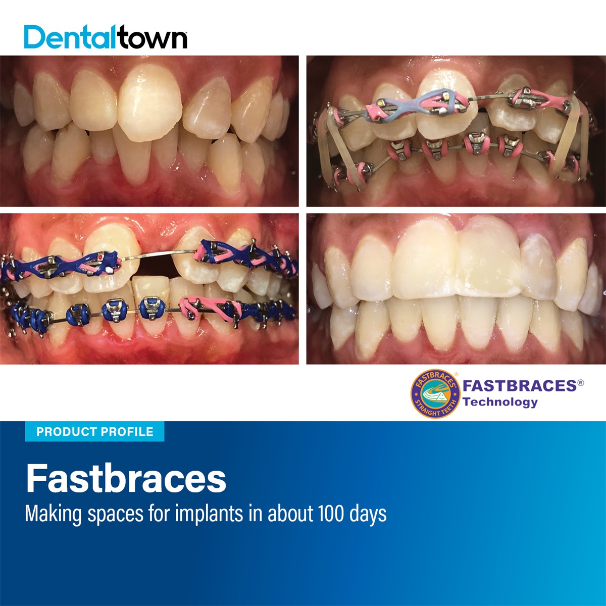 Product Profile: Fastbraces Making spaces for implants in about 100 days