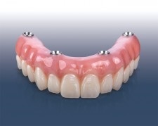 Glidewell Introduces Aesthetic Zirconia Version of BruxZir Implant Prosthesis