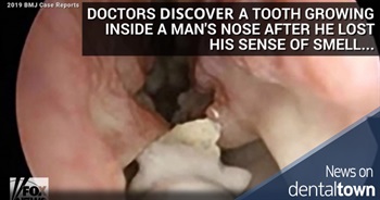 Tooth pulled from inside man's nose after losing sense of smell