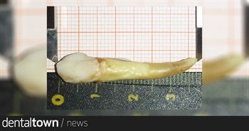 1.46-inch tooth pulled by dentist declared world's longest by Guinness