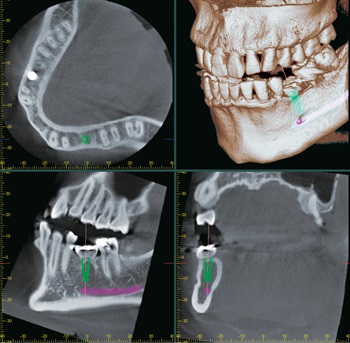 3D Diagnostix Digital Services Now Integrated with Morita i-Dixel Imaging Software