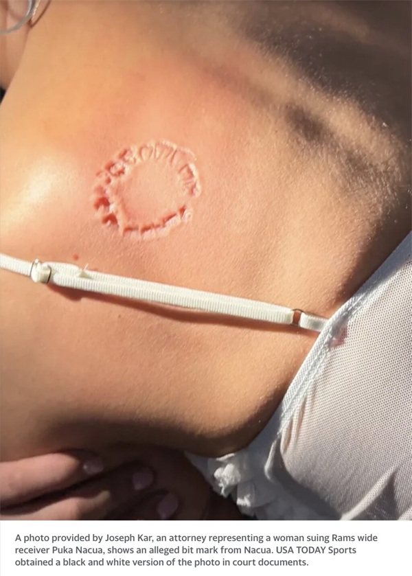Puka Nacua Bite Mark Lawsuit Raises Questions About Forensic Odontology