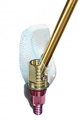 Implant Direct's Smartbase Engaging Abutment Receives 510(K) Clearance