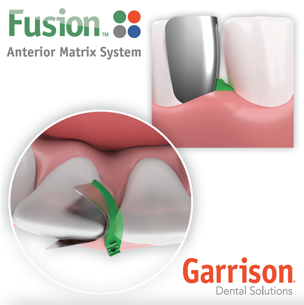 Garrison Releases Fusion Anterior Matrix System