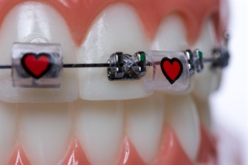 Snapcaps Announces New Product For Braces