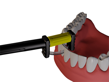 Strauss Releases Magic Strip System