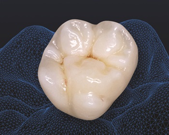 Assured Dental Lab Introduces Z-Brux
