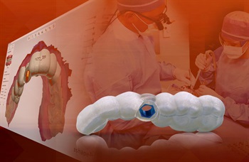 Glidewell Laboratories Announces Surgical Guides With Digital Treatment Planning Service