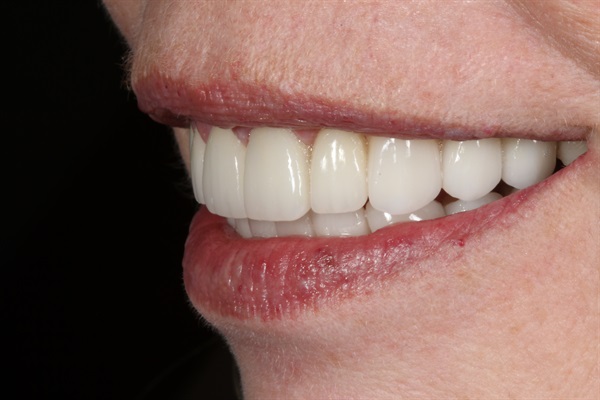 Aesthetic Full Mouth Rehab ... Where to Learn?