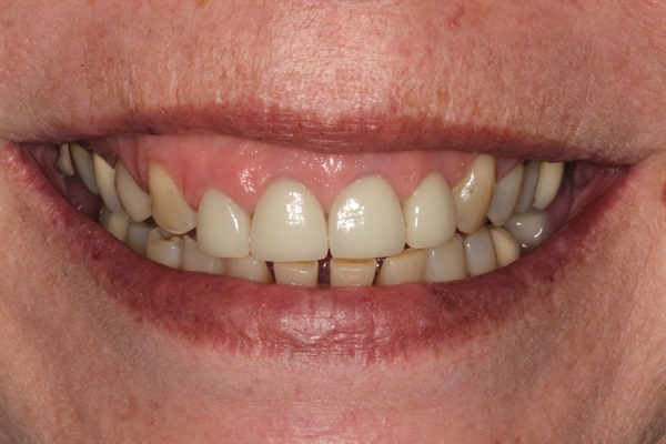 Aesthetic Full Mouth Rehab ... Where to Learn?