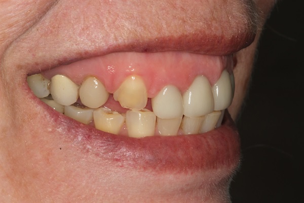 Aesthetic Full Mouth Rehab ... Where to Learn?