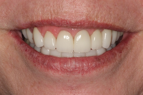 Aesthetic Full Mouth Rehab ... Where to Learn?