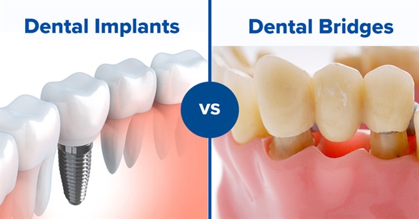 Ceramic Implants - A Bio-Friendly Alternative
