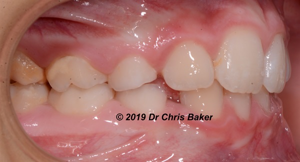 Upside Down and Inside Out: The New Wisdom in Orthodontic Treatment