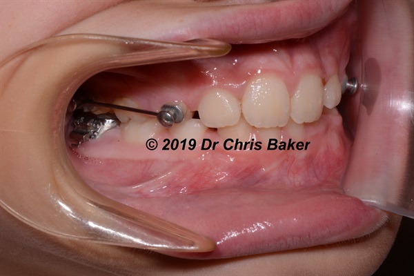 Upside Down and Inside Out: The New Wisdom in Orthodontic Treatment