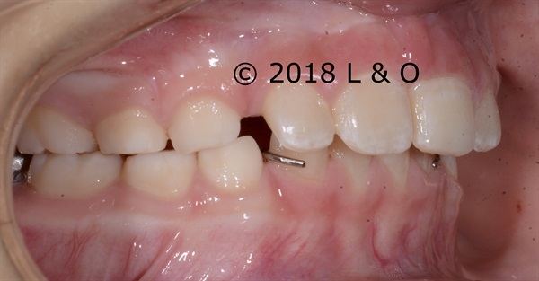 Answers to questions about Pediatric Orthodontics