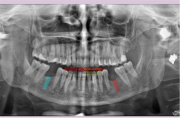 MONONOBLOCK IMPLANT DIAMETER 9 MM. IMPLANTES VALLADOLID, DR  ANTONIO REY GIL