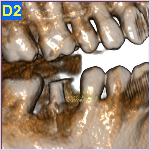 MONONOBLOCK IMPLANT DIAMETER 9 MM. IMPLANTES VALLADOLID, DR  ANTONIO REY GIL
